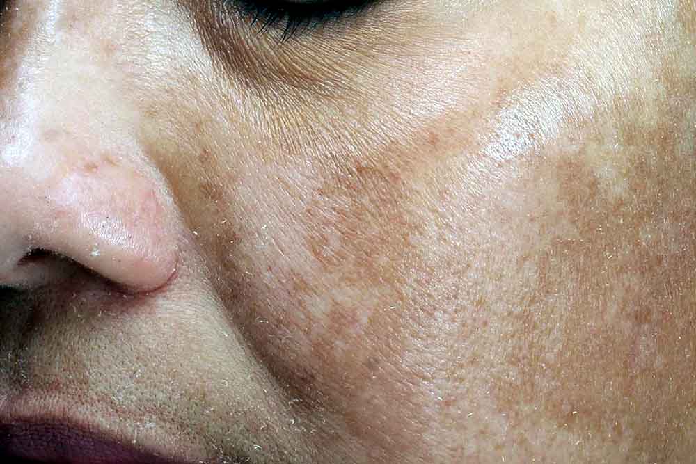 understanding dark spots and what causes them