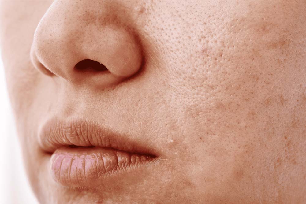 common causes of dull and tired facial skin