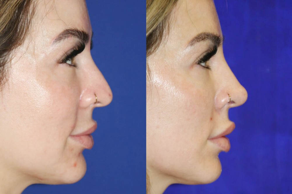 nose-filler-results